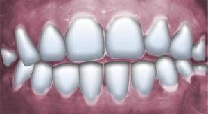 Dream interpretation for Teeth, tooth